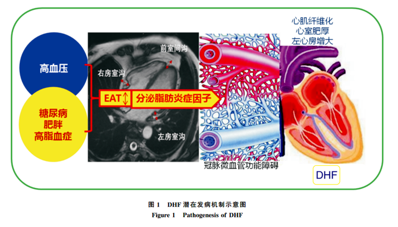 芪苈强心胶囊被列入《舒张性心力衰竭早期防治专家建议（2021）》